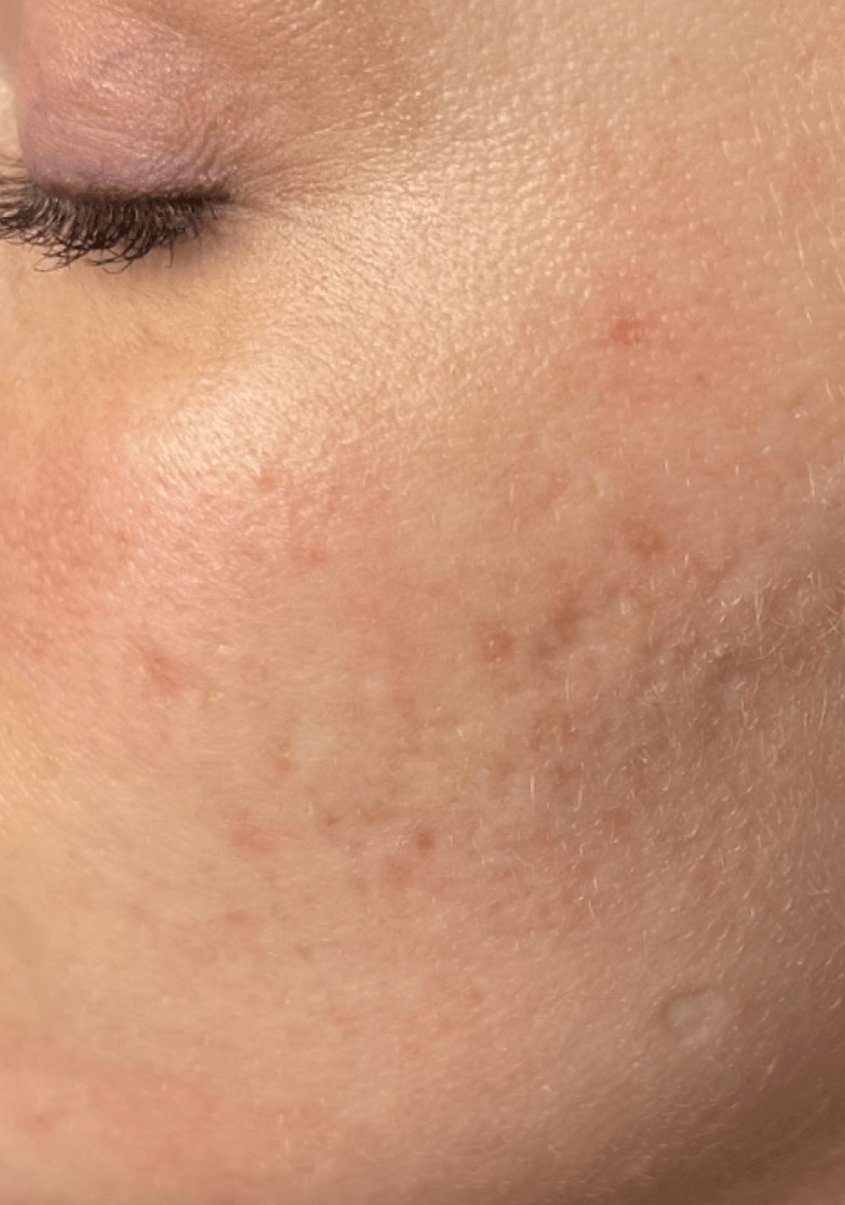 CCRM’S Microneedling results
