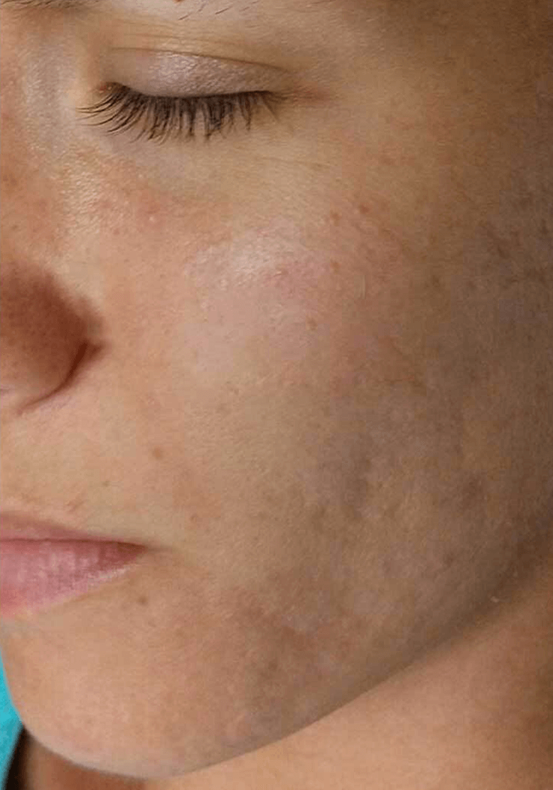 SKINPEN PRECISION MICRONEEDLING after