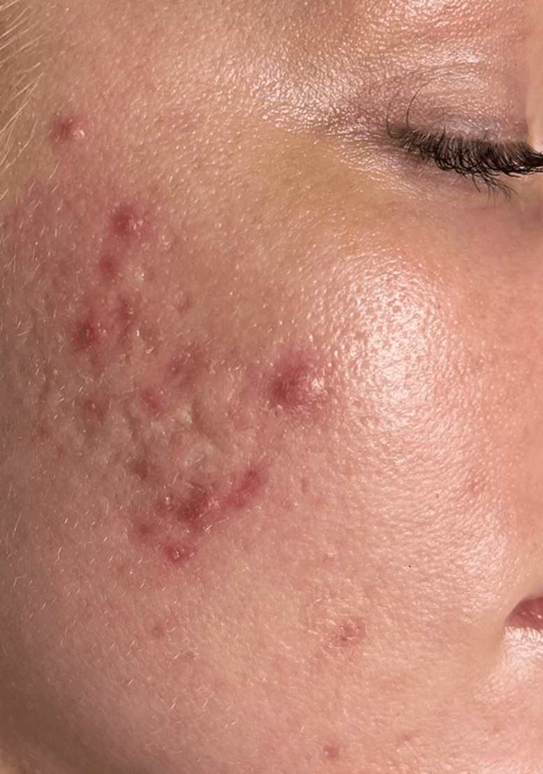 WRINKLES/ MODERATE ACNE before