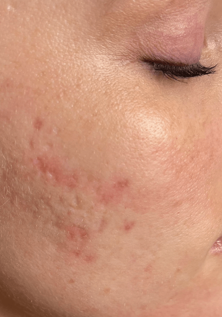 WRINKLES/ MODERATE ACNE after